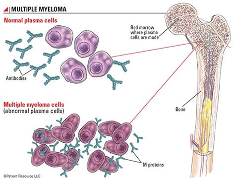 myeloma   bones diagnostics therapies  dangers peoplebeatingcancer