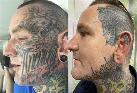 rid  face tattoos  laser tattoo removal