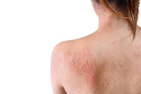 common skin rashes  pictures