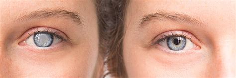 cataract surgery lyons eye care