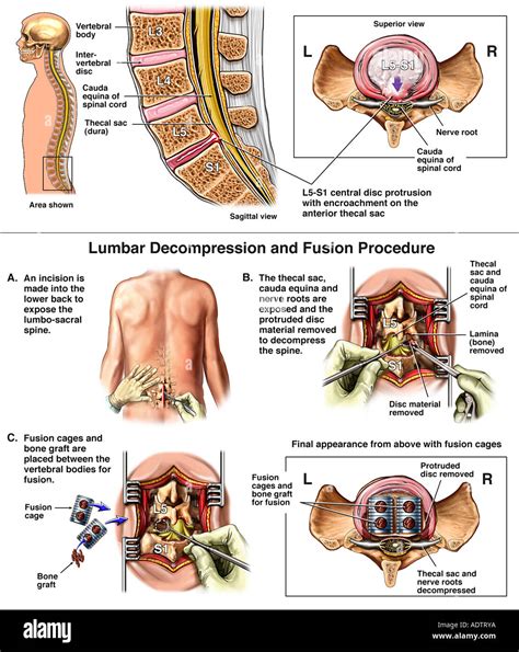 Lumbar Spine Injury L5 S1 Disc Herniation With Posterior