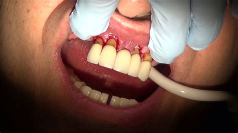 removal of multiple teeth due to advanced periodontal disease youtube