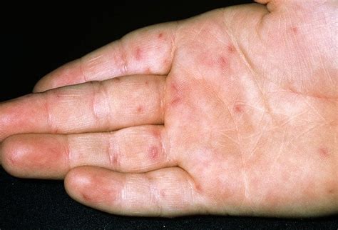 hand foot and mouth disease symptoms stages treatment