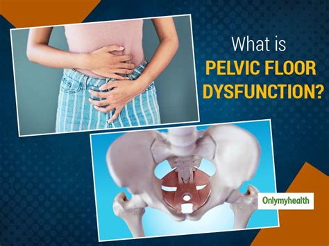 Find Out What To Do If You Have Pelvic Floor Dysfunction