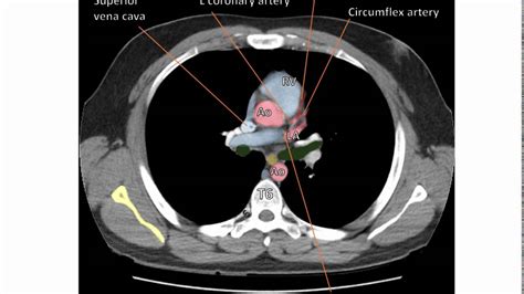 anatomy   transverse ct   thorax youtube