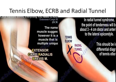 tennis elbow ecrb  radial tunnel syndrome orthopaedicprinciplescom