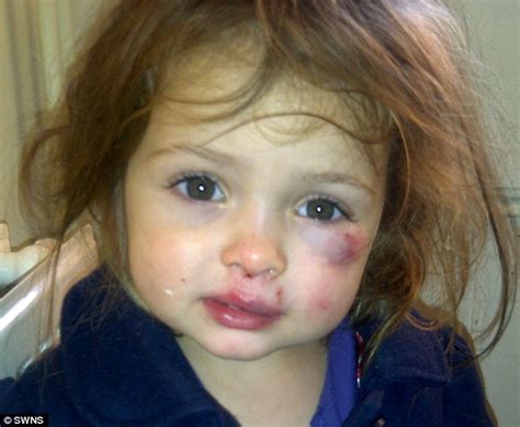 Katie Ann Guttridge 3 Attacked At Leicester Nursery By A 2 Year Old