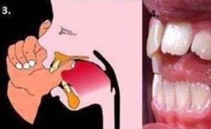 kebiasaan buruk penyebab maloklusi kelainan susunan gigi jb dental