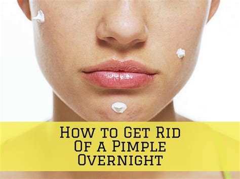 how to get rid of pimples overnight fast and naturally