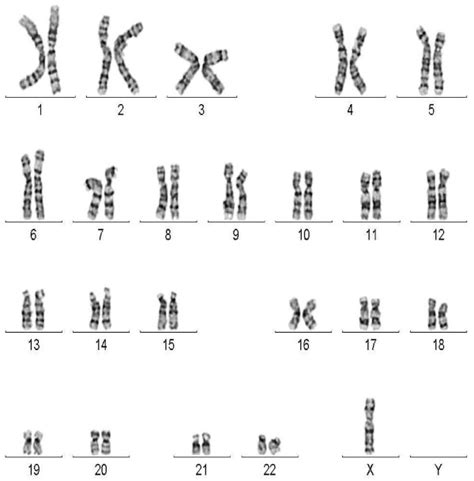 G Banded Karyotype Showing A Cell Line With Monosomy X Download