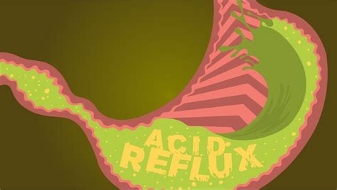 your burning chest how to stop acid reflux and gerd unc