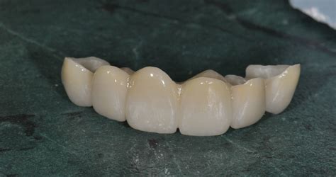 zirconia  ceramic restoration prestige dental carecommy