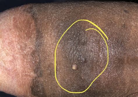 graphic pimple on penis sexual health forums patient