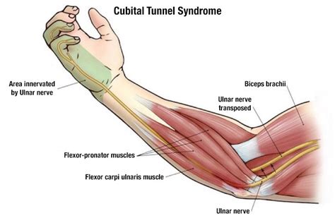 Cubital Tunnel Syndrome Test Precision Medical Group
