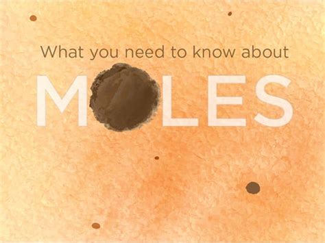 Holy Moly 5 Signs Of A Melanoma Mole
