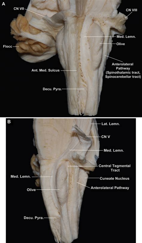 anterolateral view   medulla oblongata neuroanatomy