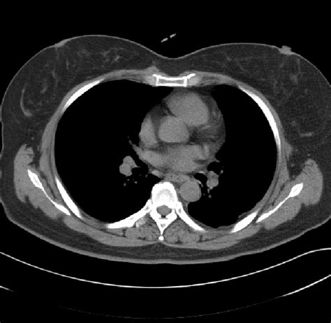 Post Operation Chest Ct Shows Normal Location And Slow Growth It