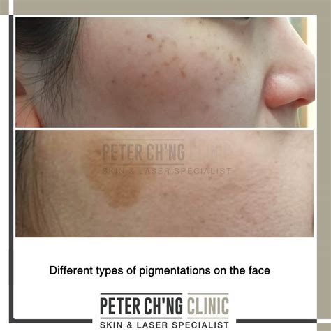 age spots freckles  hyperpigmentation peter chng skin specialist kl malaysia