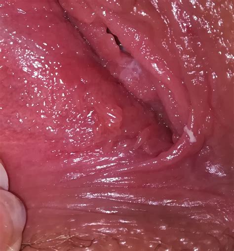 Hpv Or Vp Pleas Help Sexual Health Forums Patient
