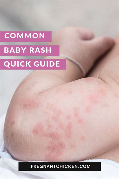 pics  diaper rash understanding  common skin condition  babies martlabpro