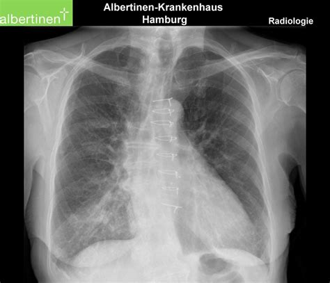 chest  ray aspiration pneumonia