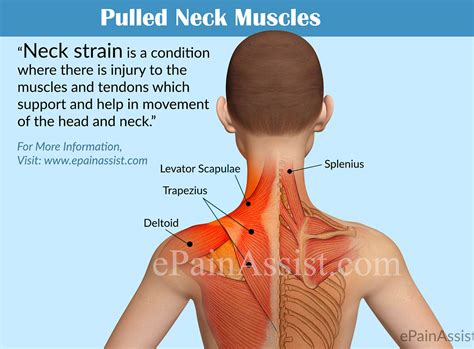 Pulled Neck Muscle Or Neck Strain Causes Symptoms Treatment Diagnosis