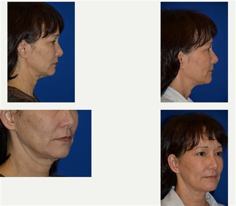 months post ultherapy  cheeks  neck  levels womens health