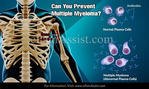 prevent multiple myeloma