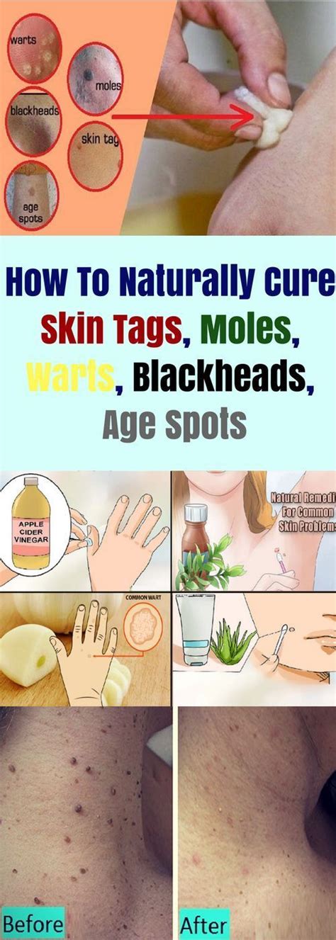 how to naturally cure skin tags moles warts blackheads