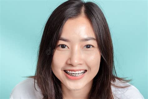 Dental Braces Of Young Asian Woman Wearing Braces Beauty Smile With