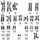 Karyotype Blindness Color Chromosomes Human Lab Genetics Involved Autosomal Inheritance Ch Biology Do sketch template