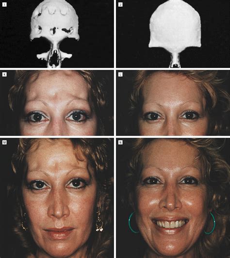 Reconstruction Of The Frontal Sinus And Frontofacial