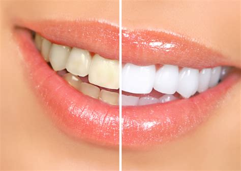 pros and cons of teeth whitening strips teeth poster