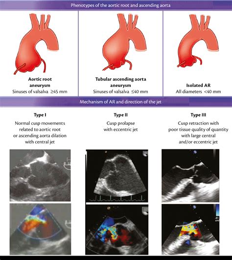 figure  definition  aortic root  ascending aortic phenotypes