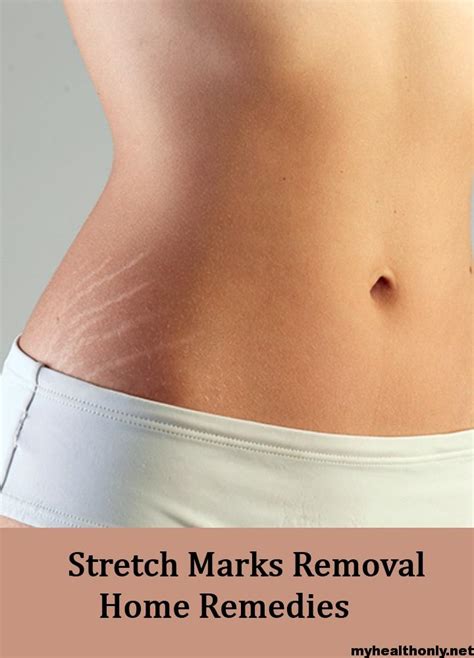 Let Us Tell You How To Remove Stretch Marks Easily My Health Only