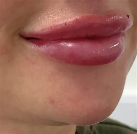 advanced lip fillers including russian lip medics and non medics