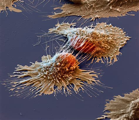 cancer cells   electron microscope pics