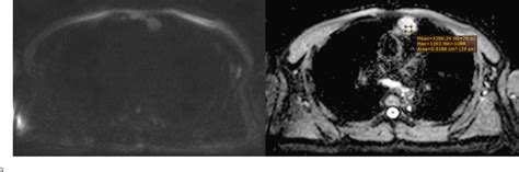 Figure 9 From Role Of Diffusion Weighted Mri In Differentiation Between