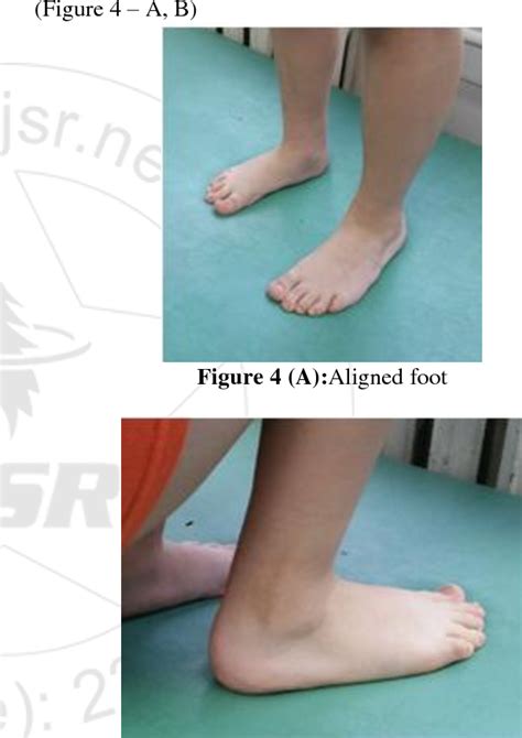 Figure 4 From The Role Of Anterior Tibial Muscle Tendon Transfer As A