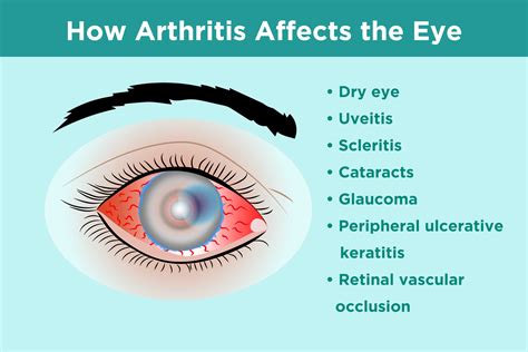 inflammatory arthritis  eye health prevention symptoms treatment