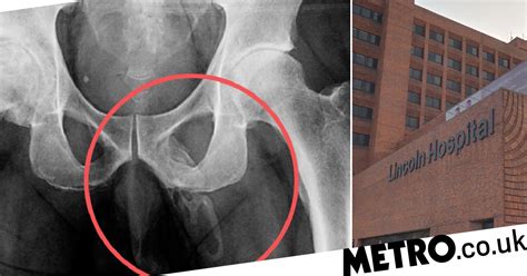 man s penis is slowly turning into bone due to rare condition metro news