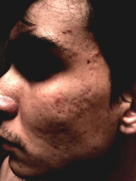 acne scar and diagnosis hypertrophic raised scars