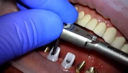 bad odor    dental crown oral health