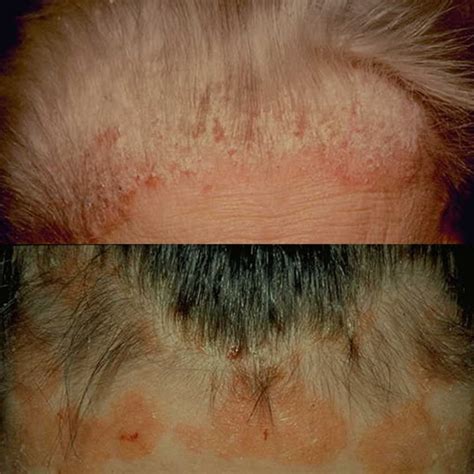 natural scalp psoriasis treatment  tea tree oil  olive oil