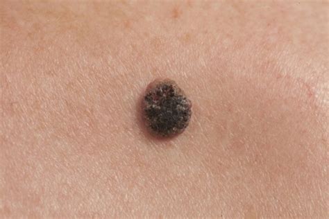 10 Deadly Signs Of Skin Cancer You Need To Spot Early Page 6 Topmannews