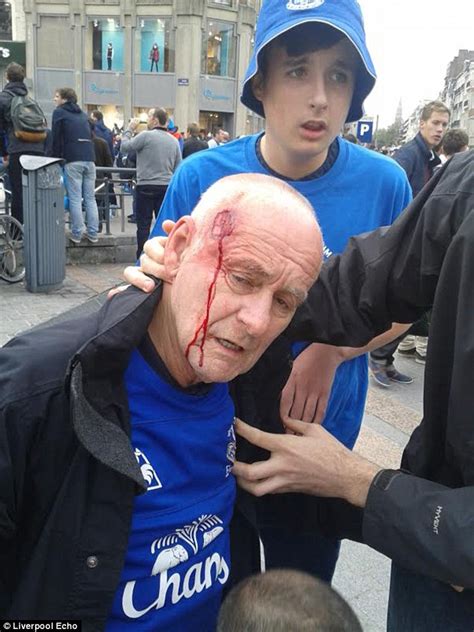 everton fan and grandfather shot in head with rubber bullet says i could have died daily