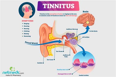 tinnitus  symptoms  treatment