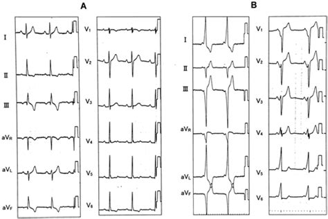 T Wave Abnormalities On Preoperative Electrocardiogram Caused By