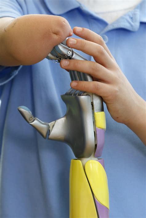 Ohsu Ucf Launch First U S Clinical Trial Of 3d Printed Prosthetics