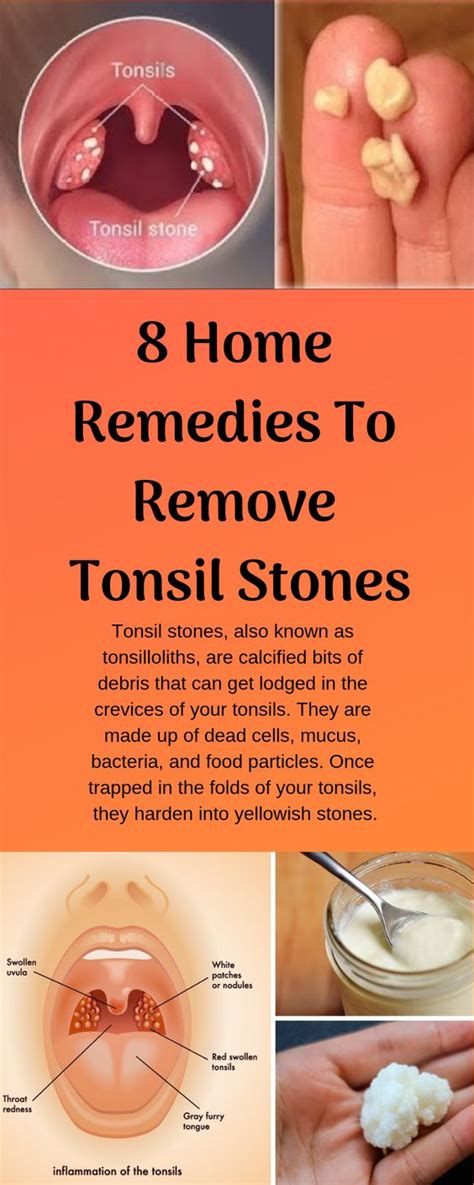 remove tonsil stones  cotton swab howotremvo